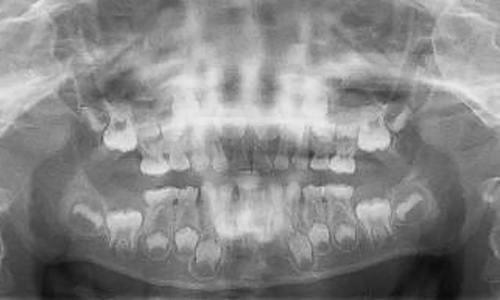 レントゲン 乳歯 子供が転倒して乳歯を強打！レントゲンの診断結果と治療内容