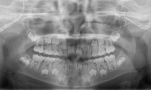 レントゲン 乳歯 歯の数が足りない先天性欠損